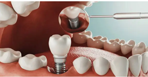 dental implants Adelaide